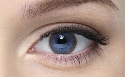 Kayser-Fleischer Rings - Wilson Disease Association